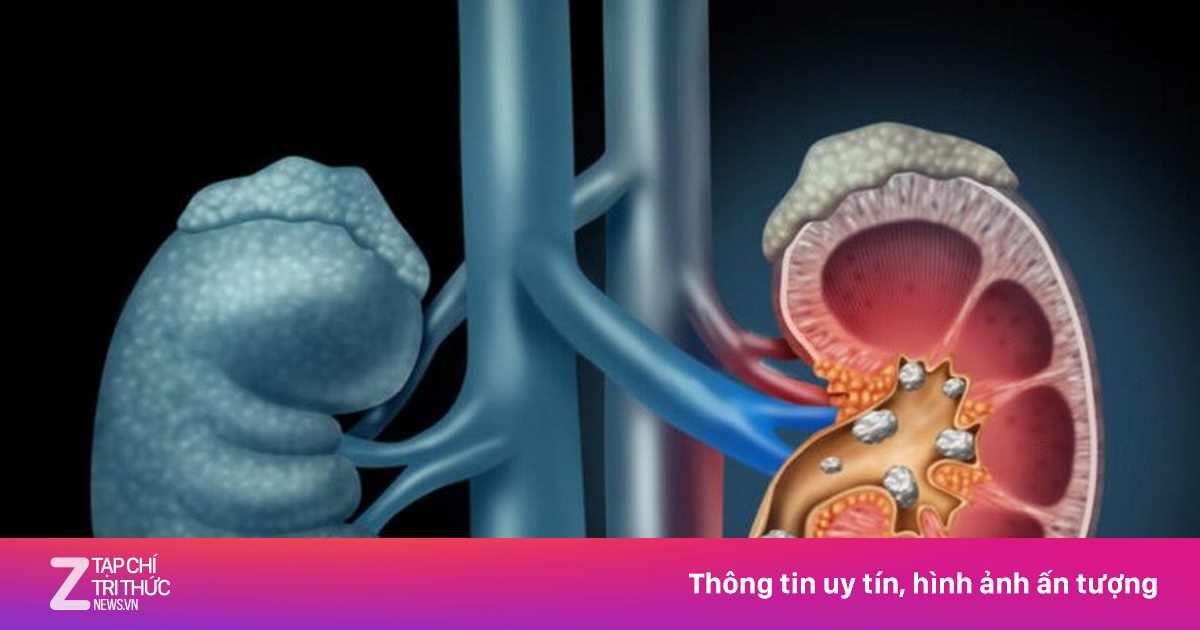 Thận bị tổn thương nghiêm trọng bởi những sai lầm trong cách uống nước