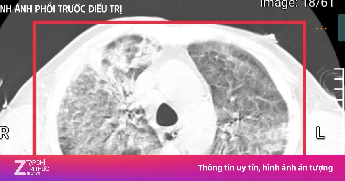 Người đàn ông trở về từ Thái Lan, mang theo vi khuẩn 'tử thần'