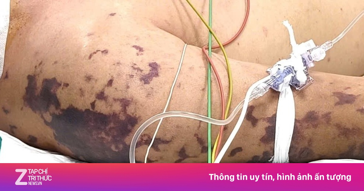 Thâm tím khắp người sau bữa tiệc vì nhiễm khuẩn não mô cầu