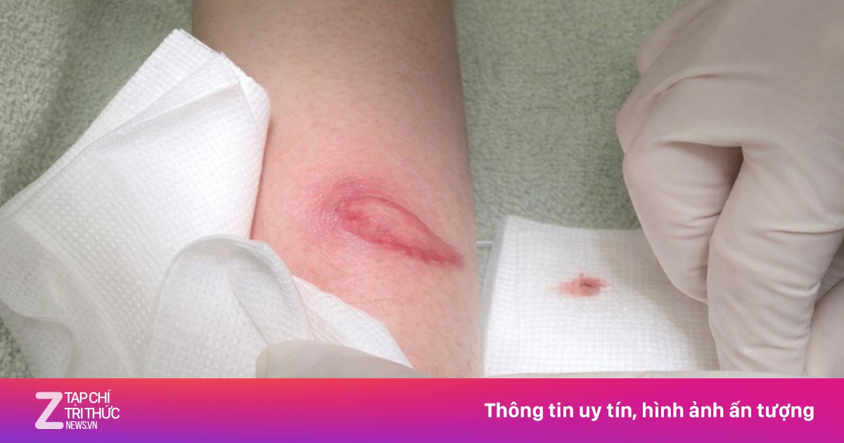 Gánh hậu quả đau lòng vì nôn nóng tiêm filler vòng ba