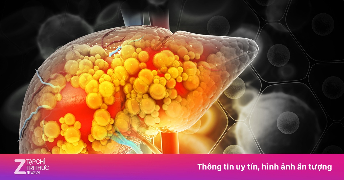 Thói quen xấu khó bỏ gây tổn thương gan nghiêm trọng, nhiều người vẫn làm hàng ngày