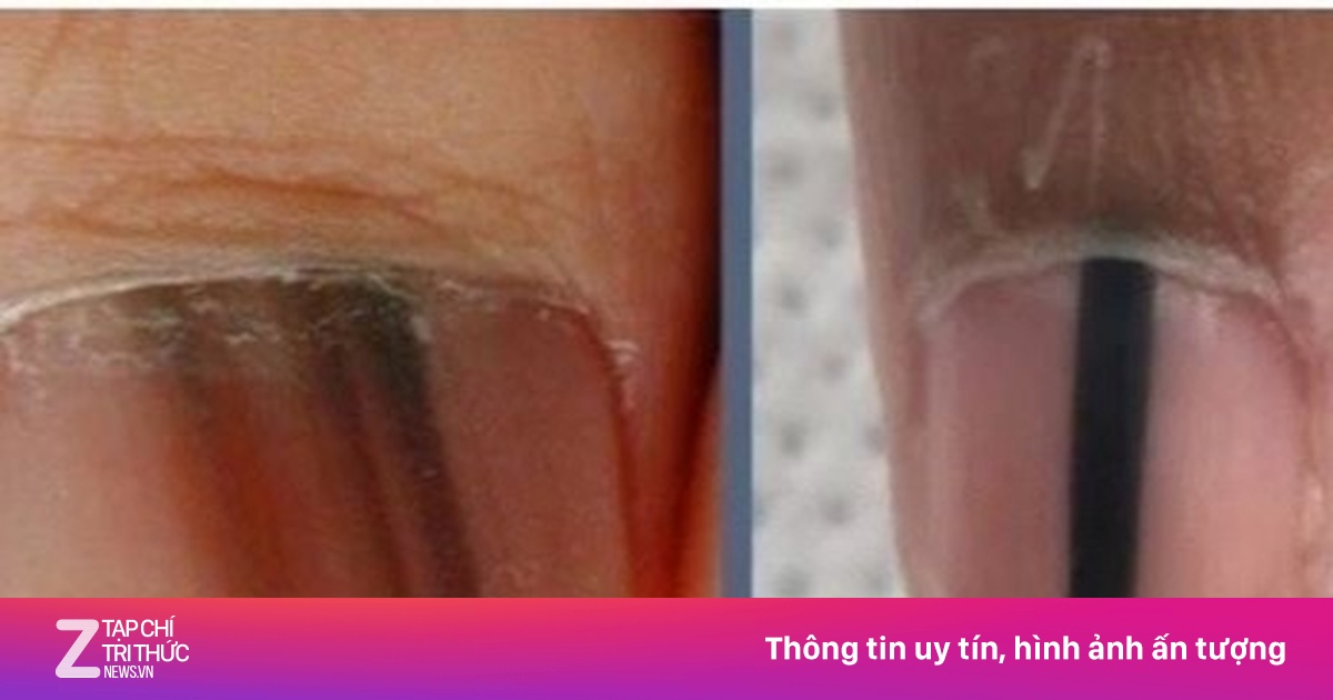 Sọc sẫm màu trên móng tay, móng chân là biểu hiện của bệnh gì?