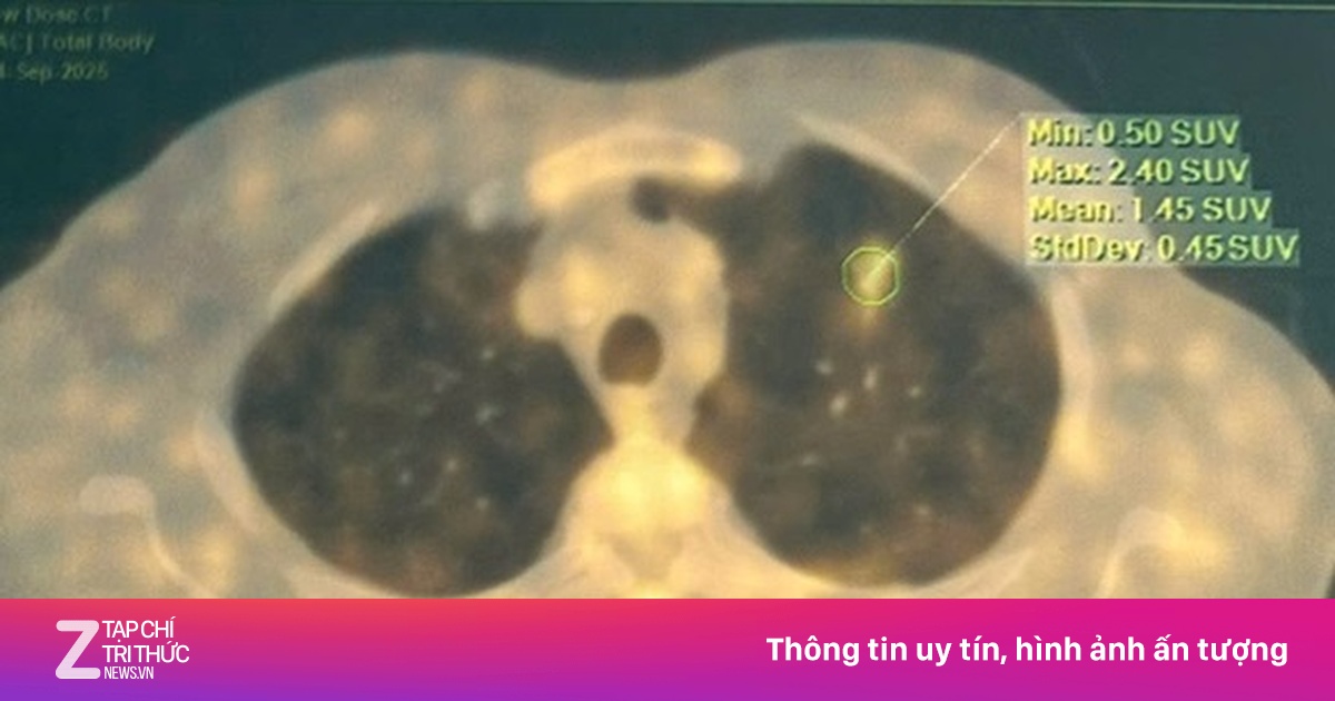 Thói quen khó bỏ suốt nhiều năm khiến người đàn ông mắc ung thư