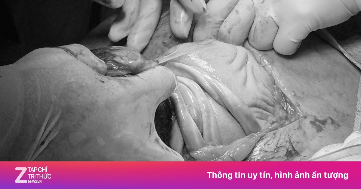 Em bé chào đời với dây rốn quấn cổ 4 vòng