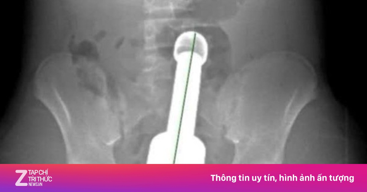 Thiếu niên 15 tuổi vào viện khẩn cấp vì chiếc chày 18 cm trong hậu môn