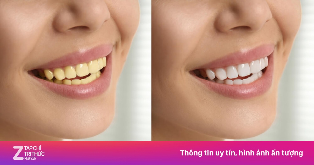 Cách cải thiện răng bị ố vàng