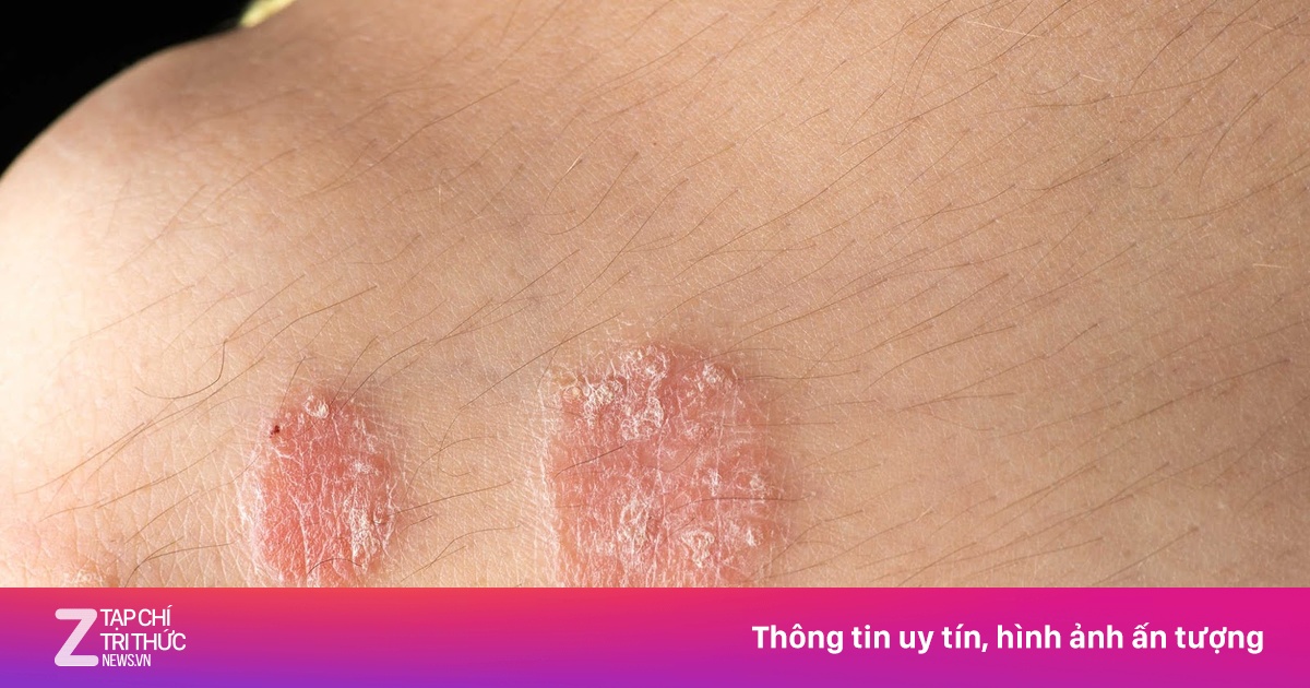 Cảnh giác với 4 biểu hiện lạ trên da có thể là dấu hiệu HIV