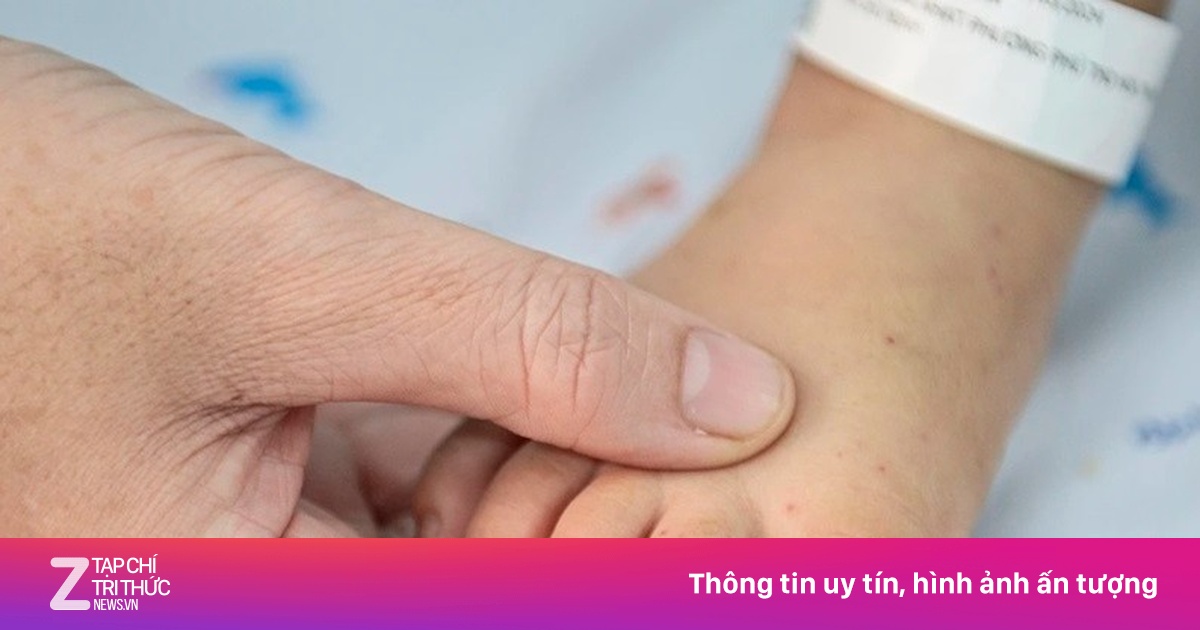 Dồn dập ca tay chân miệng nhập viện, bác sĩ cảnh báo virus EV71