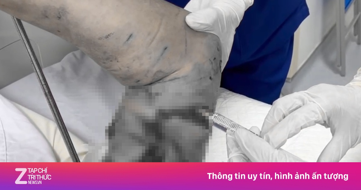 Nhập viện trong tình trạng thương tâm vì bị chó becgie cắn xé