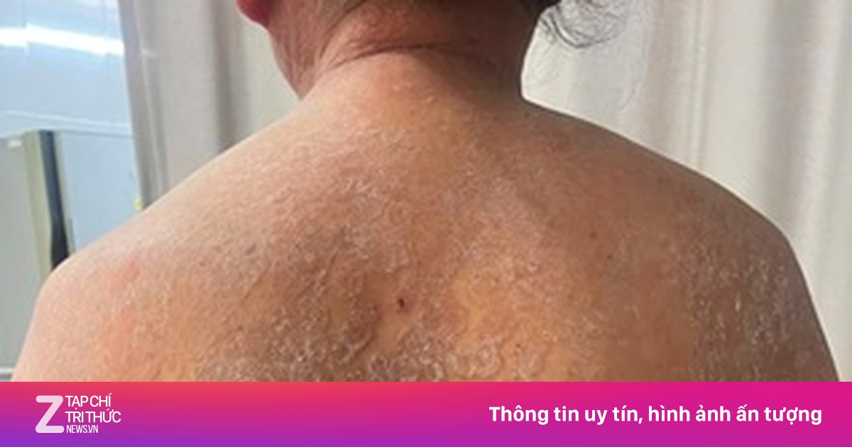 Nấm Phủ Kín Cơ Thể Sau 2 Năm Tự Ý Điều Trị Vết Ngứa: Bài Học Đắt Giá