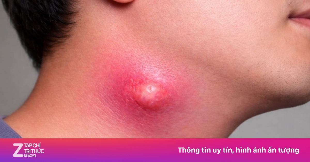 5 dấu hiệu ở cổ cảnh báo ổ mủ nguy hiểm đang âm thầm phát triển