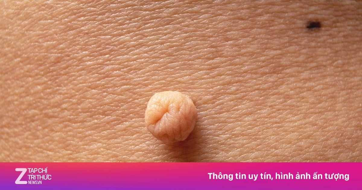 Sùi mào gà trẻ hóa, đường lây truyền ngày càng phức tạp và khó nhận biết