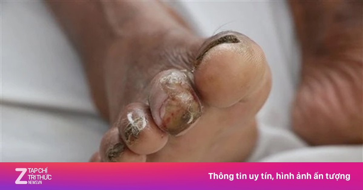 Thái Lan cảnh báo khẩn về bệnh Whitmore: Bộ Y tế Việt Nam ra hướng dẫn phòng ngừa