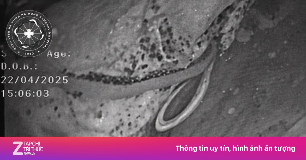 Bác sĩ kinh ngạc khi nội soi đại tràng cho bệnh nhân