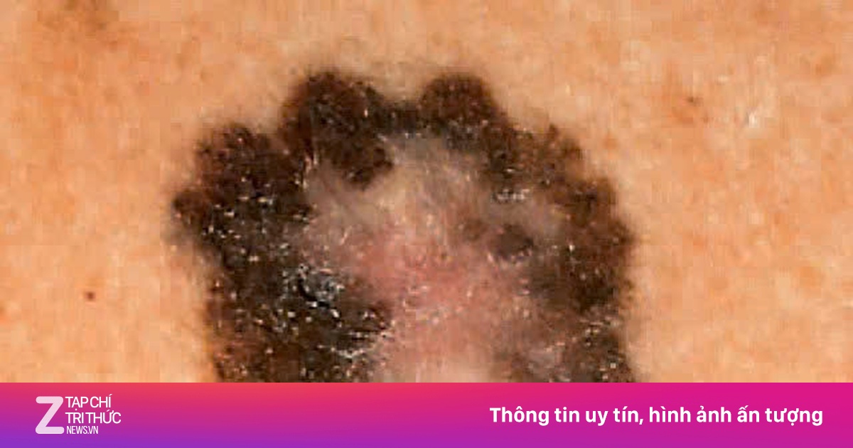 Ba lần lên bàn mổ vì khối u ung thư 'ăn' ngầm dưới mặt