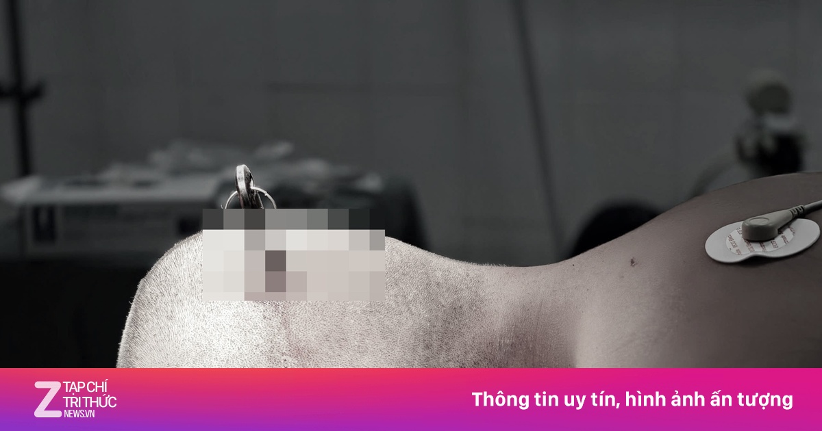 Nam sinh nhập viện với chiếc chìa khóa đâm xuyên sọ