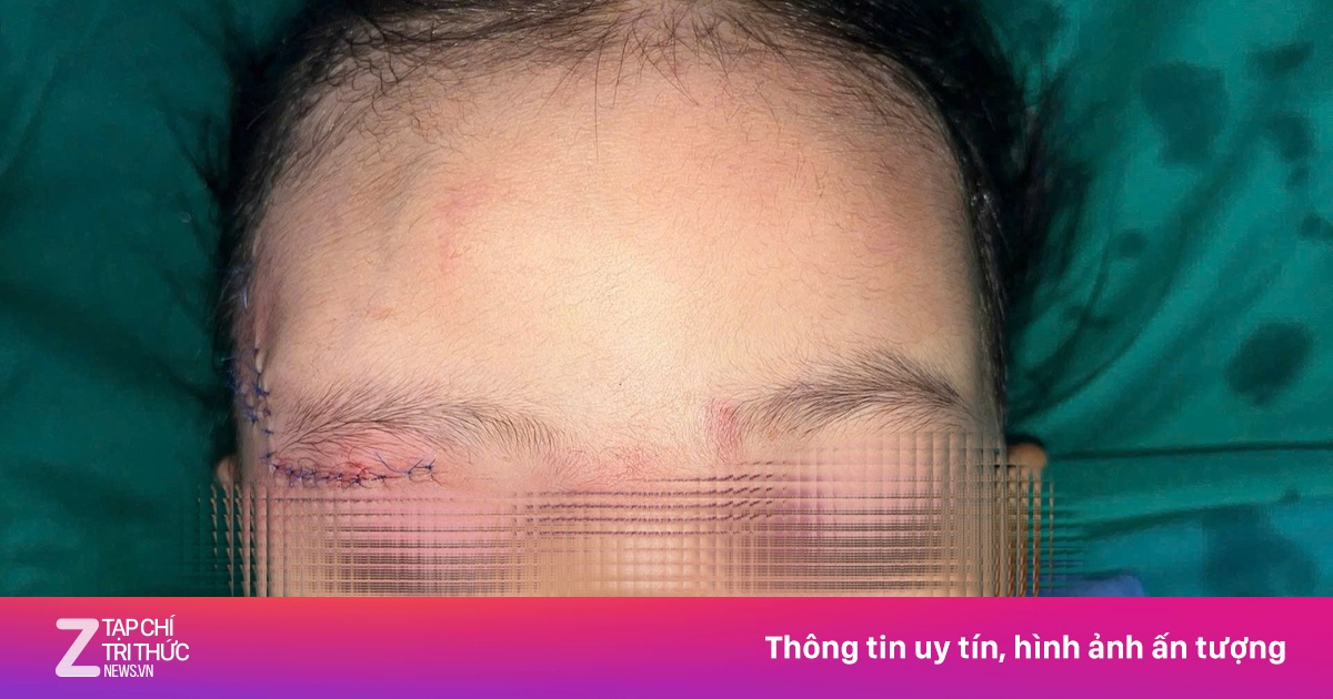 Bé gái 2 tuổi nhập viện thương tâm do bị chó cắn