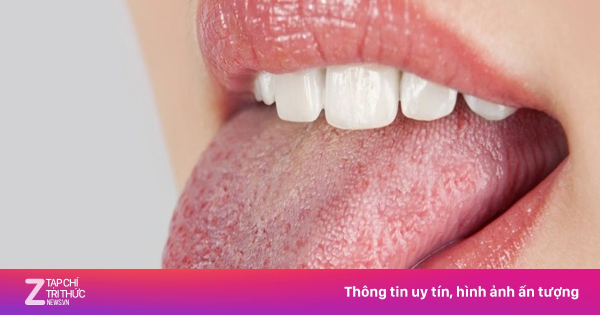Mảng trắng lan rộng, đau rát miệng lưỡi là dấu hiệu bệnh gì?