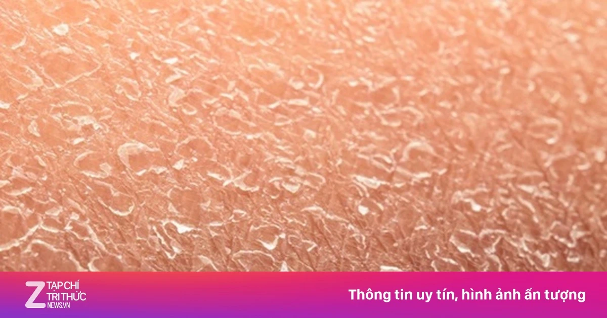 Bệnh hiếm khiến làn da liên tục bong tróc suốt đời