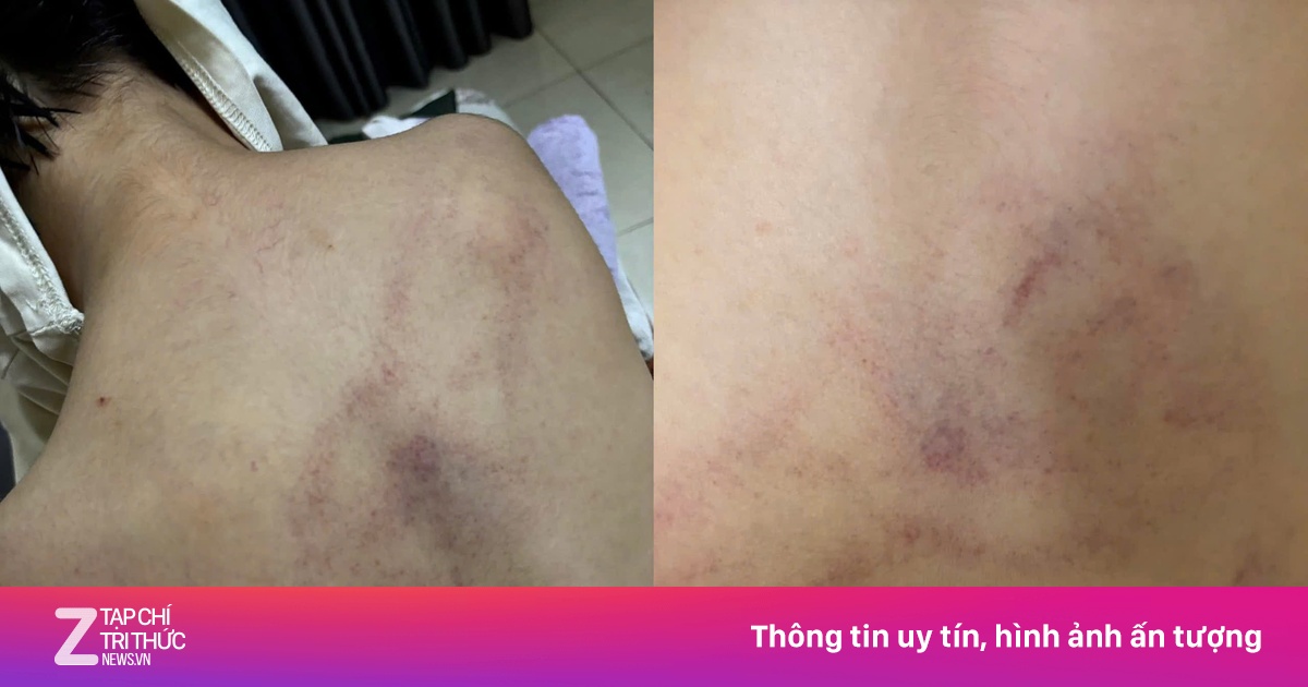 Phụ huynh tố con bị giáo viên 'đánh đập thô bạo, ném vào tường'