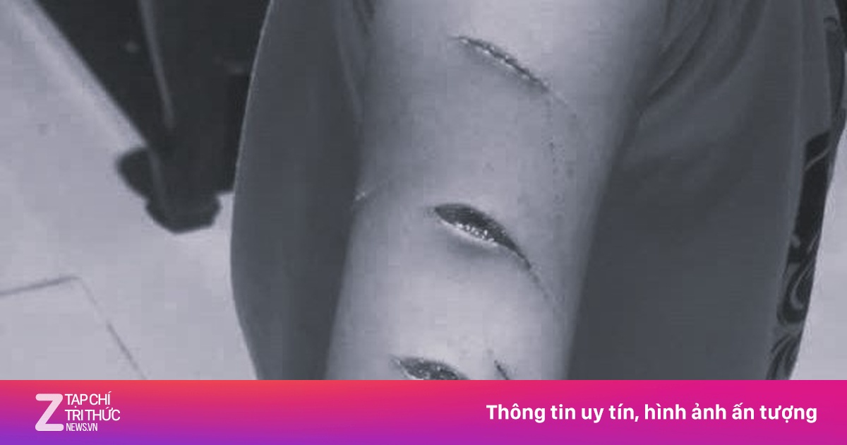 Học sinh bị chị họ dùng dao rạch nát tay, cô giáo vội báo gia đình