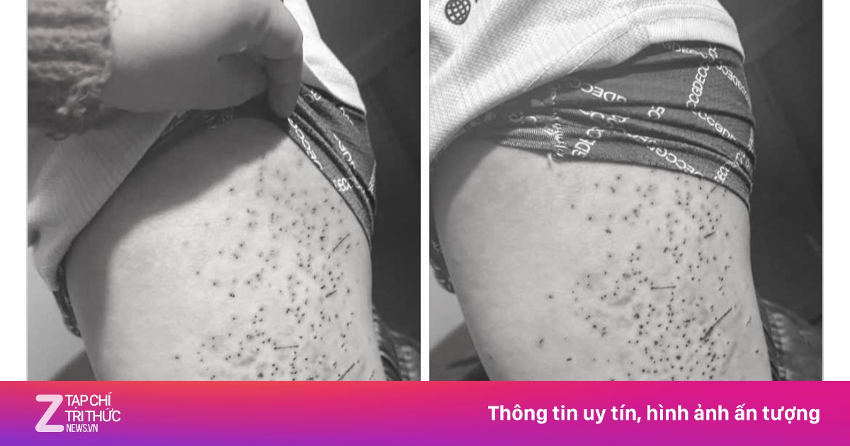 Học sinh lớp 7 bị bạn dùng bút bi đâm chi chít vào đùi