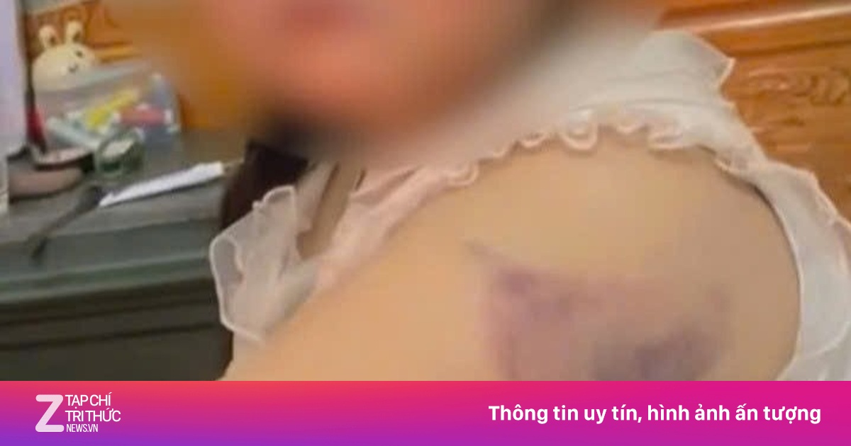 Học sinh lớp 1 nghi bị cô giáo đánh bầm tím tay vì viết chữ xấu