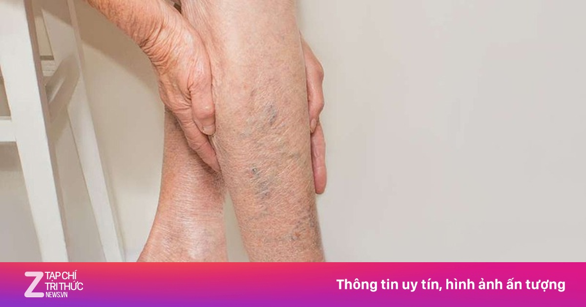 Các yếu tố nguy cơ gây suy tĩnh mạch chi dưới