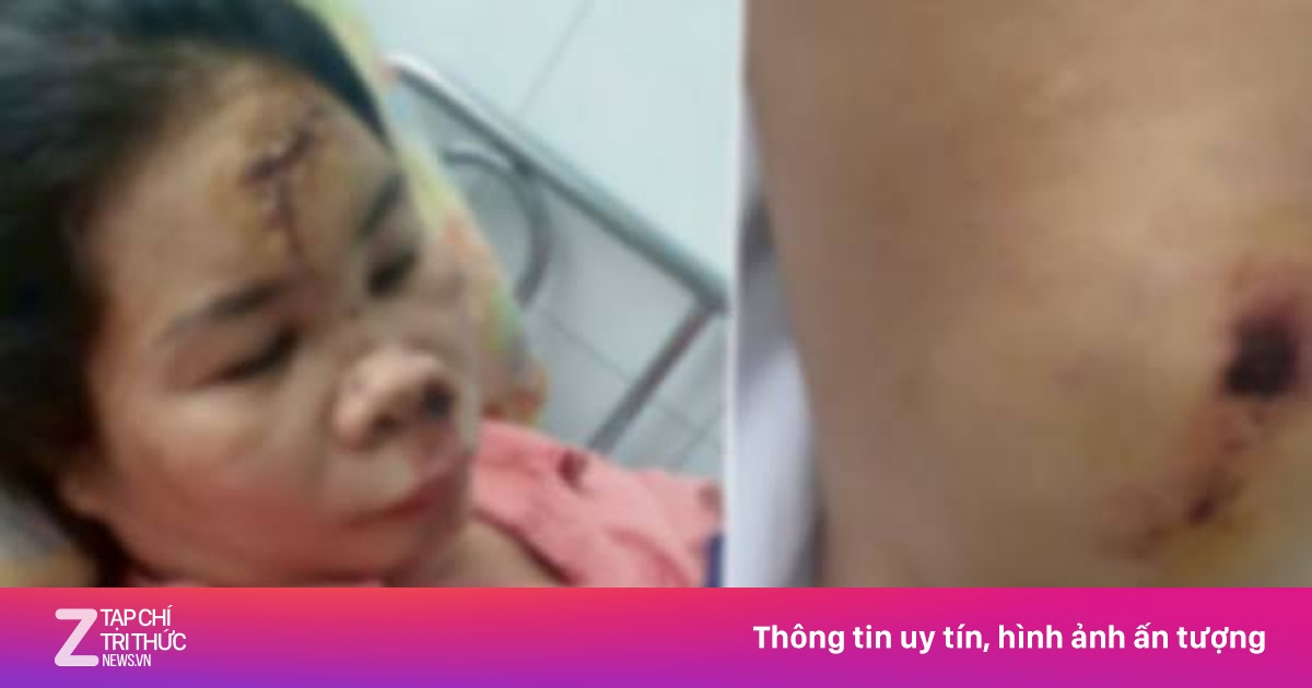 Xác minh thông tin vụ cướp giật khiến người phụ nữ bị chấn thương