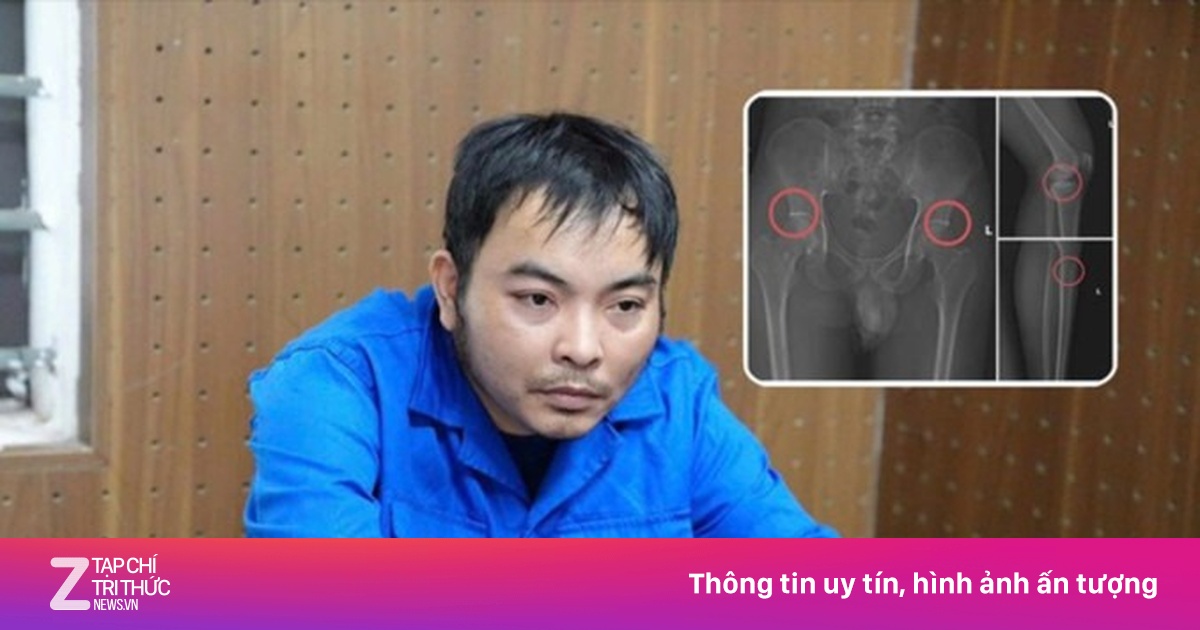 Cựu nhân viên y tế đục vỡ xương trục lợi bảo hiểm: Thủ đoạn tàn nhẫn