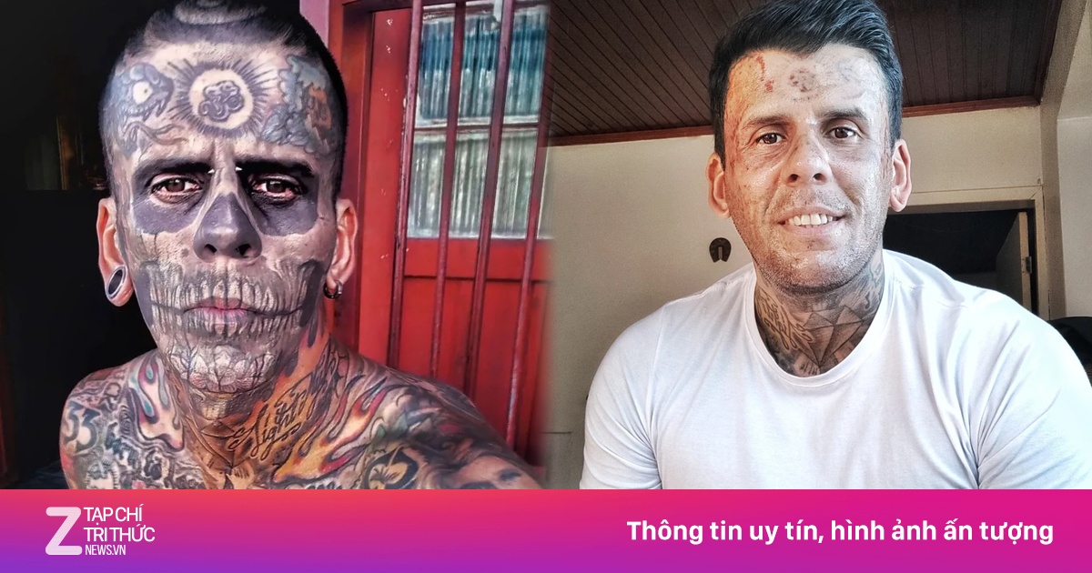 Quá trình xóa xăm đau đớn của người đàn ông 'phủ mực' 95% cơ thể