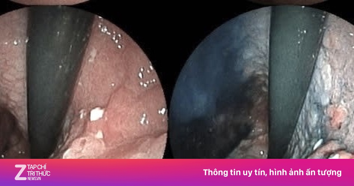 Doanh nhân Indonesia sang TP.HCM mổ ung thư đại tràng tắc ruột