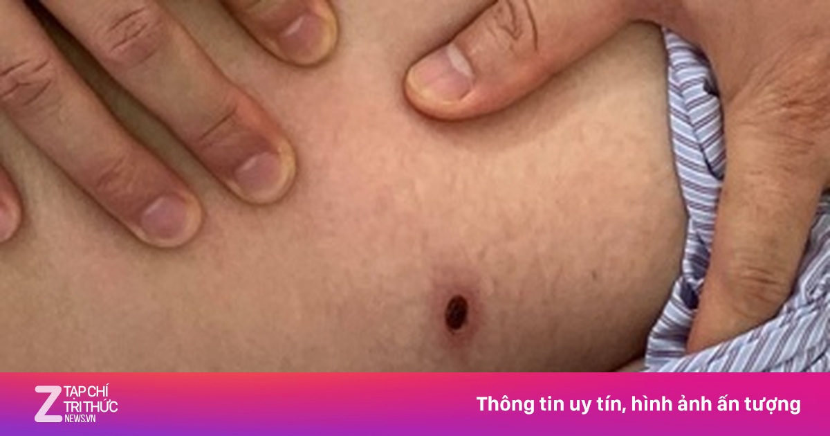 Sốt 4 Ngày Không Dứt, Phát Hiện Vết Loét Ở Đùi Là 'Thủ Phạm' Gây Bệnh