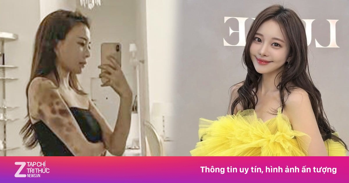 Hot girl Hàn bàng hoàng khi cả cơ thể bầm tím sau 2 giờ gây mê làm đẹp