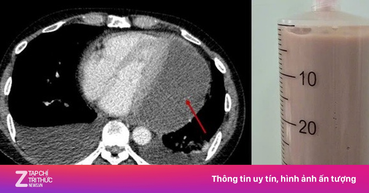 Người đàn ông nghiện rượu có mủ đặc quánh bao quanh tim hiếm gặp