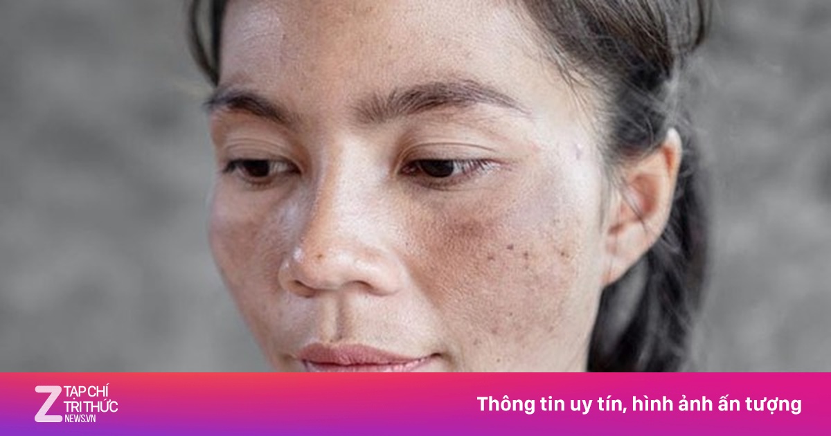 7 vấn đề về da mùa hè có thể ngăn ngừa