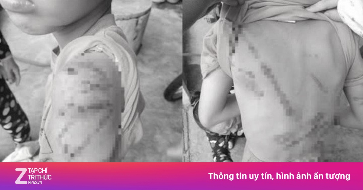 Học sinh lớp 4 ở Đắk Lắk bị cha đánh bầm tím cơ thể