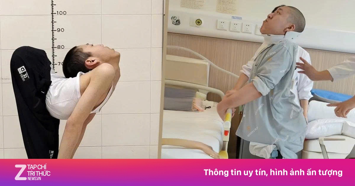 'Cậu bé người gập' Trung Quốc lần đầu tiên đứng thẳng sau 15 năm
