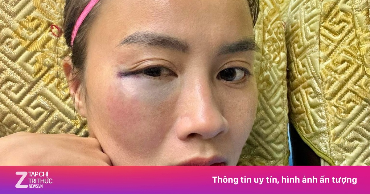 Gương mặt sưng vù của hot girl bóng đá sau va chạm