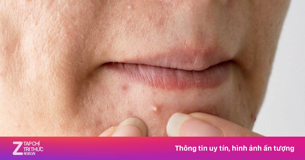 Mối liên hệ giữa mụn trứng cá và đường
