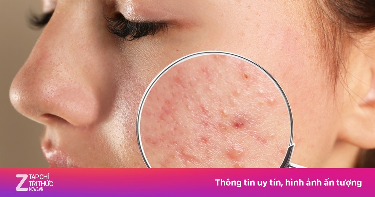Nguyên nhân gây mụn trứng cá mà nhiều người bỏ qua