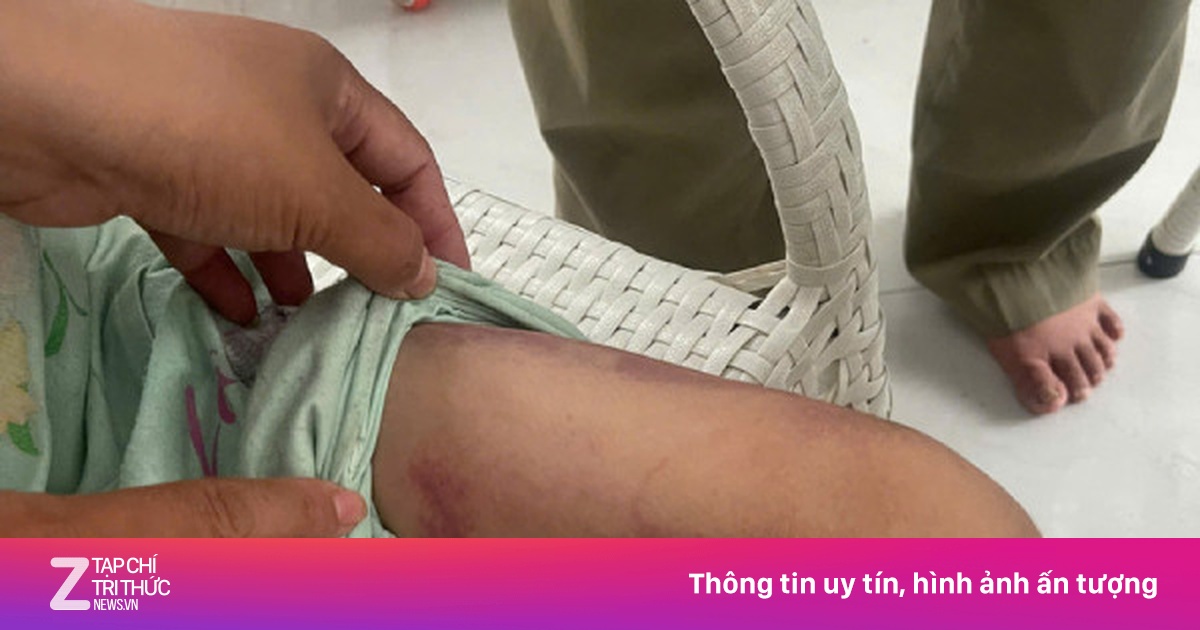 Bé gái 9 tuổi bị người tình của mẹ bắt nhúng lưỡi vào nước sôi