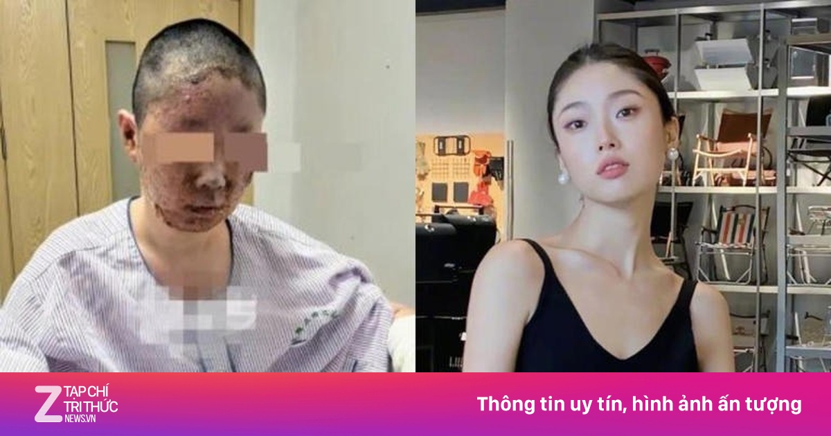 Người mẫu Đồng Dao biến dạng khuôn mặt sau vụ nổ kinh hoàng