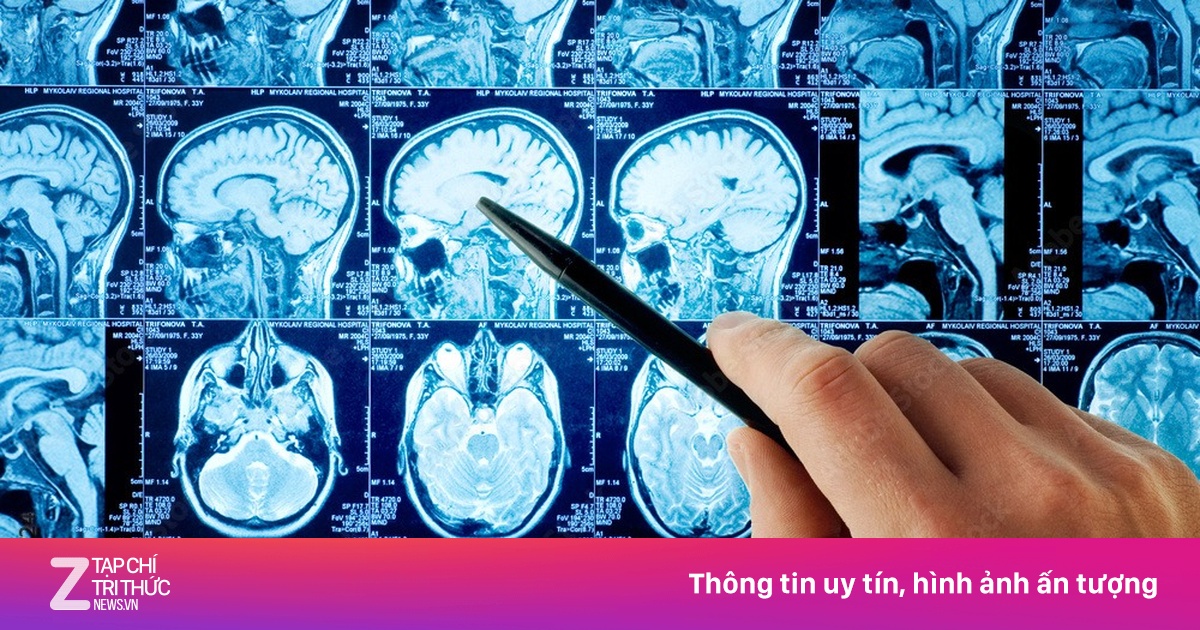 Yếu tố di truyền khiến cả làng mắc bệnh Alzheimer