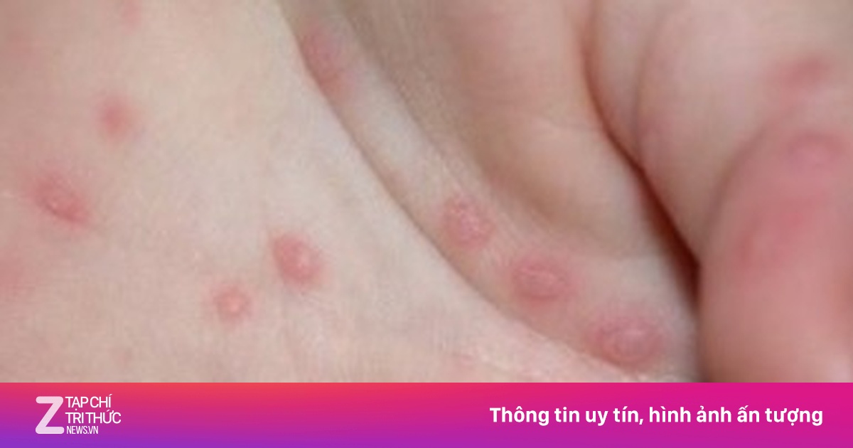 Bệnh tay chân miệng dùng thuốc như thế nào?