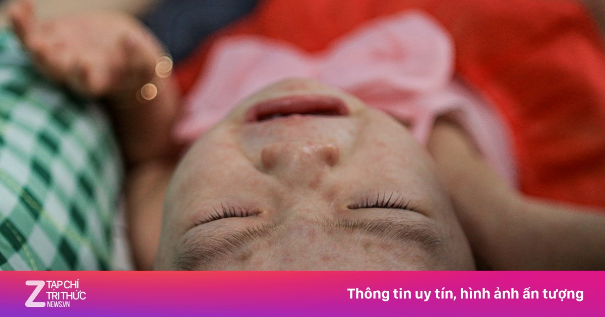Phân biệt bệnh sởi và sốt phát ban