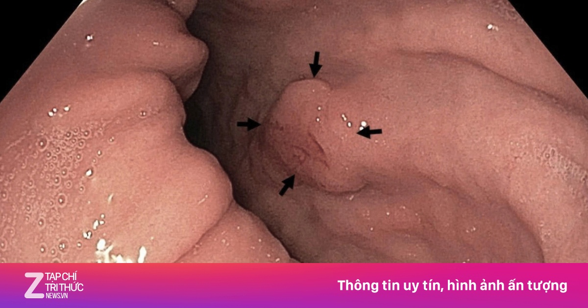 33 tuổi, người phụ nữ mắc ung thư dạ dày giai đoạn cuối