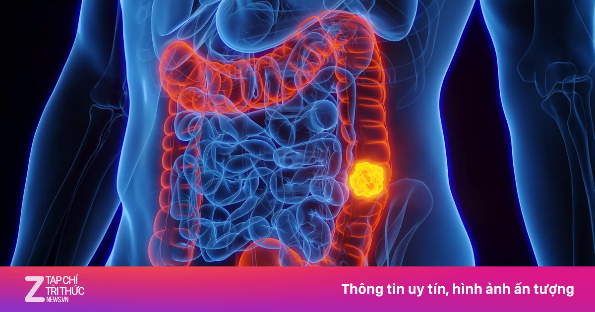 Điều gì xảy ra khi mắc ung thư đại trực tràng
