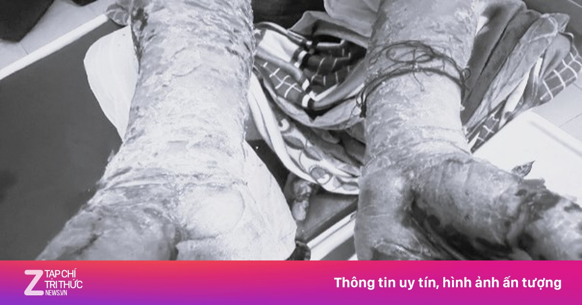 Da nứt nẻ, lở loét vì thói quen nhiều người mắc phải