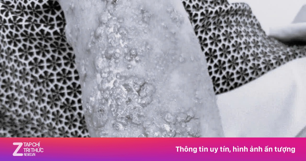 Dùng dầu gió để trị bệnh, người phụ nữ gánh hậu quả